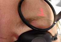 Operan frakn CO2 laser